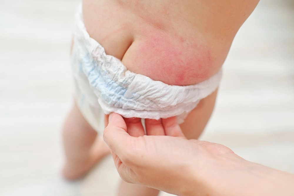 Chăm sóc bé bị hăm tã chuẩn y khoa