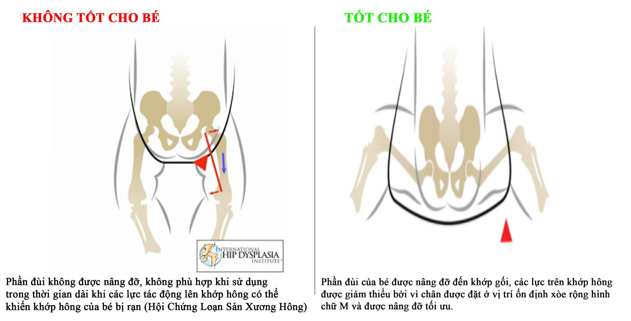 Gối cao hơn mông là tư thế địu tốt nhất