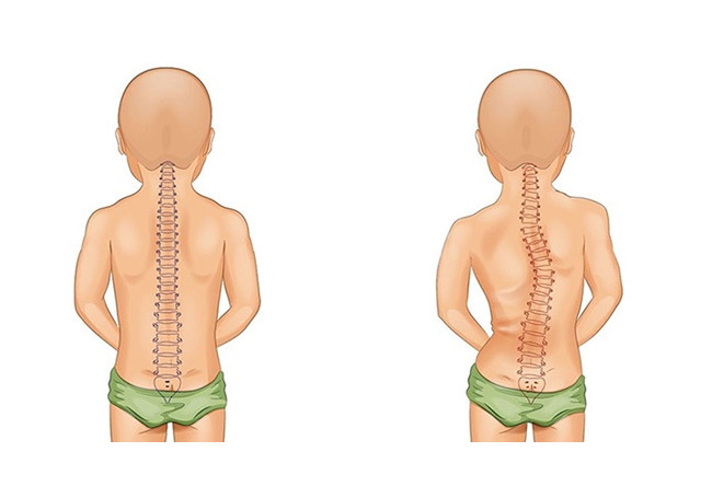 Minh họa tác hại cong vẹo cột sống do địu bé sai tư thế