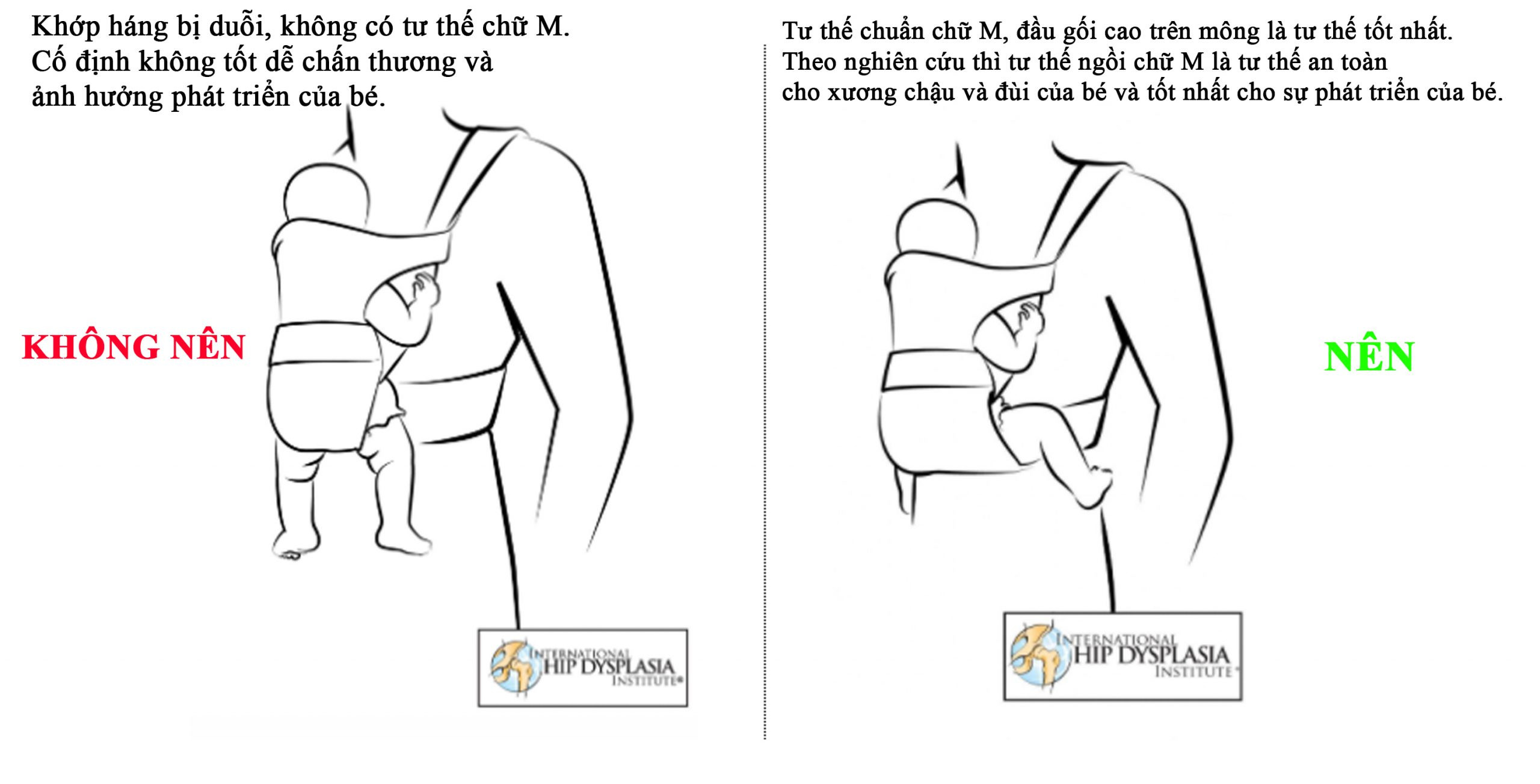 Sơ đồ minh họa tư thế chữ M chuẩn trong địu giúp tránh loạn sản khớp háng