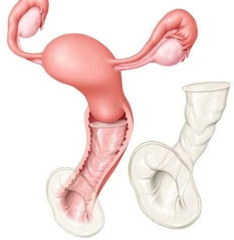 Bao cao su nữ - Giải pháp bảo vệ toàn diện sức khỏe sinh sản