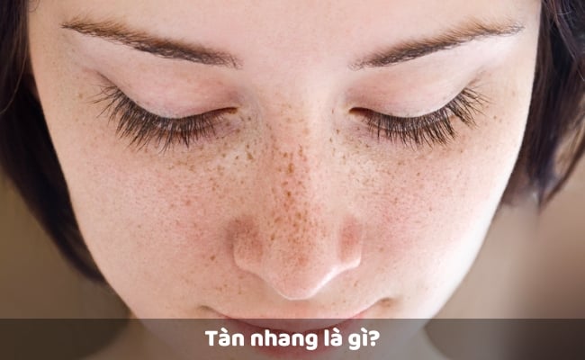 Cách Chữa Tàn Nhang Đơn Giản, An Toàn Và Hiệu Quả Từ Gốc