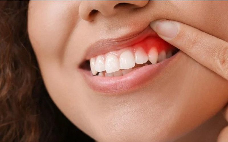 Chăm sóc răng miệng với dầu tràm