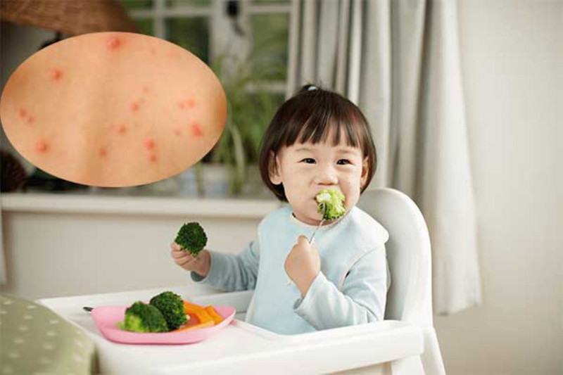 Chế độ dinh dưỡng và vệ sinh khoa học giúp trẻ sơ sinh bị thủy đậu nhanh chóng phục hồi