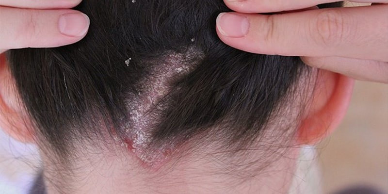 Dầu gội trị nấm da đầu hiệu quả nhanh