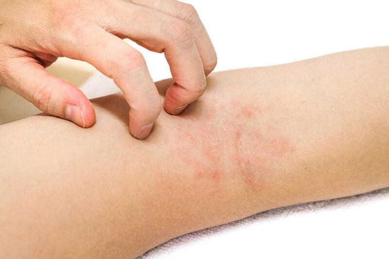 Hình ảnh người đang gãi vùng da bị nổi mẩn đỏ sau khi wax lông do kích ứng.