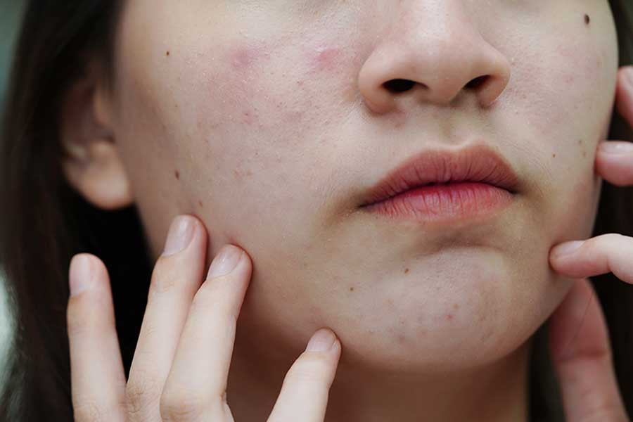 Lưu ý quan trọng: Da thải độc như thế nào để tránh tổn thương và giãn nở lỗ chân lông