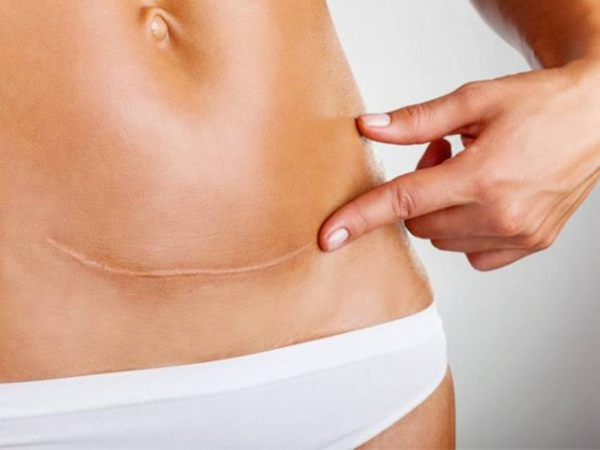 Mẹ sau sinh mổ cần chú ý thời điểm ăn rau muống