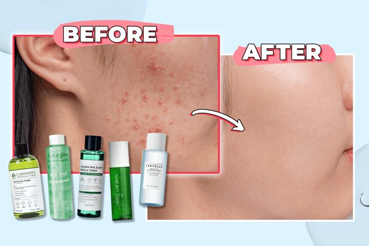 Các loại toner cho da dầu mụn hiệu quả nhất hiện nay - image 2