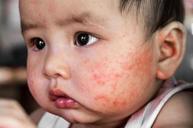 Trẻ Bị Nổi Mẩn Đỏ Trên Mặt: Nguyên Nhân, Cách Xử Lý Hiệu Quả
