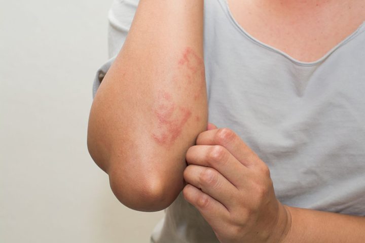 Dị ứng khi mang thai có nguy hiểm: Tổng quan và cách xử lý