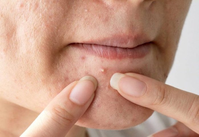 Nên Nặn Mụn Vào Thời Gian Nào Trong Ngày Để Da Phục Hồi Tốt Nhất