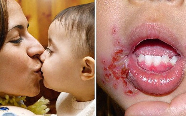 Tác Hại Của Việc Người Lớn Hôn Trẻ Sơ Sinh: Nguy Cơ Khôn Lường