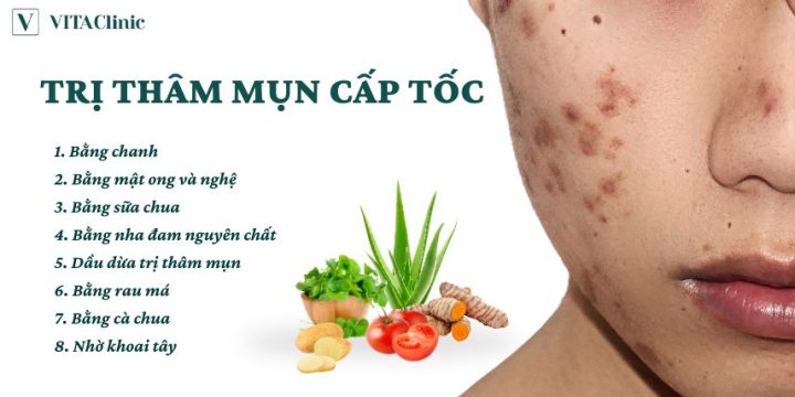 Cách Trị Thâm Trên Mặt Nhanh Nhất & Hiệu Quả Từ Chuyên Gia