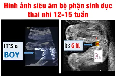 Hình ảnh siêu âm bé trai 13 tuần: Hướng dẫn chi tiết từ A đến Z
