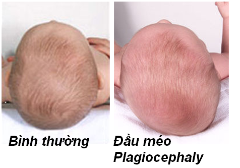 Cách Chữa Méo Đầu Cho Trẻ Hiệu Quả và An Toàn Tại Nhà