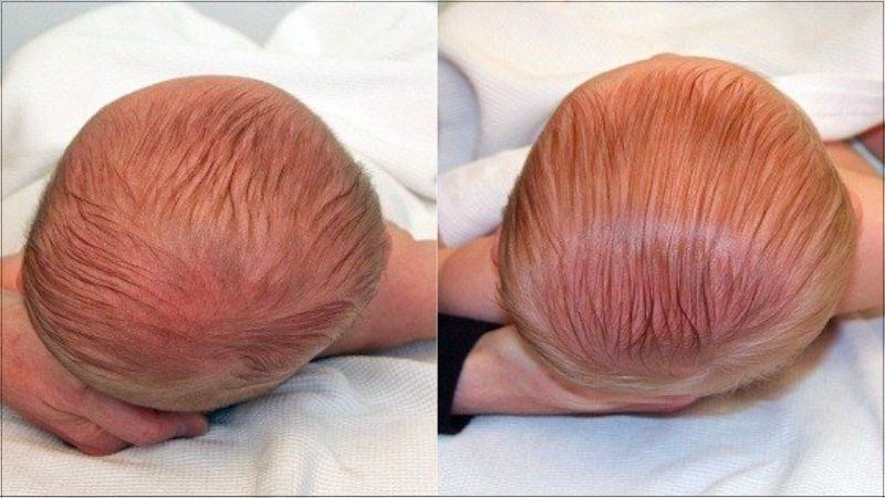 Cách Chữa Méo Đầu Cho Trẻ Hiệu Quả và An Toàn Tại Nhà