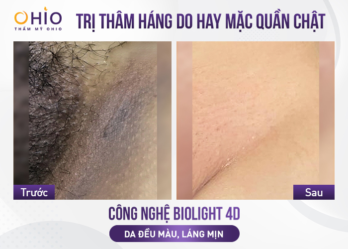 Trị Thâm Vùng Kín Sau Sinh: Giải Pháp An Toàn, Hiệu Quả Trị Thâm Vùng Kín Sau Sinh: Giải Pháp An Toàn, Hiệu Quả