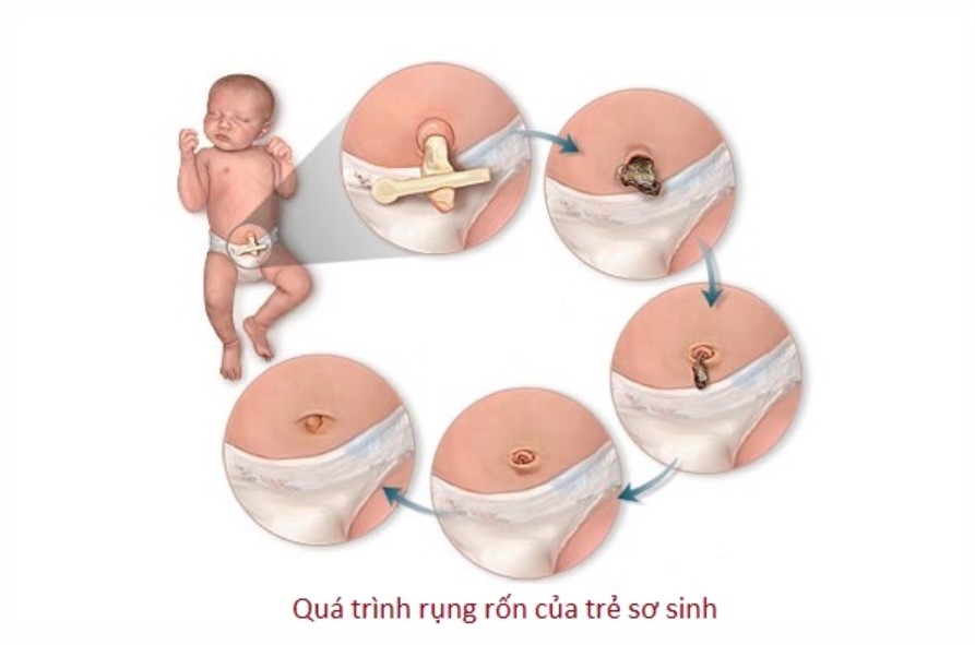 Trẻ sơ sinh mấy ngày rụng rốn? Giải đáp toàn diện về chăm sóc rốn