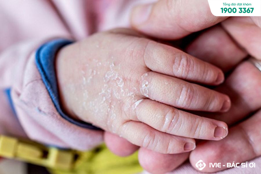Da Trẻ Sơ Sinh Bị Khô Sần: Nguyên Nhân, Nguy Cơ & Chăm Sóc Đúng Cách