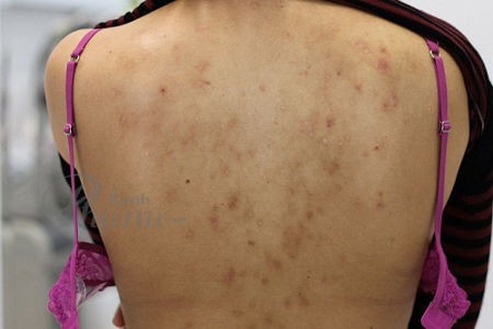Cách Trị Mụn Ở Bà Bầu An Toàn, Hiệu Quả Và Chuẩn Khoa Học