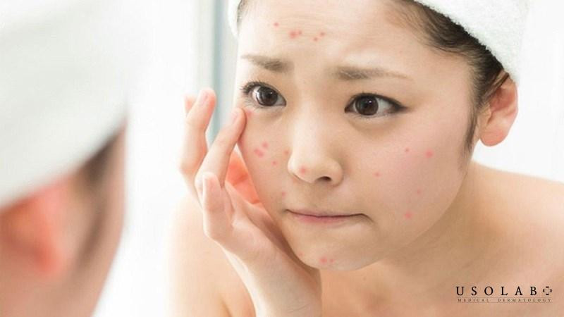 Bác sĩ da liễu đang khám da cho bệnh nhân, nhấn mạnh việc tham khảo ý kiến chuyên gia khi điều trị mụn và các dấu hiệu cần ngừng sử dụng kem trị mụn