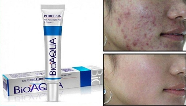 Bạn Hồng Lan Nguyễn cải thiện tình hình mụn rõ rệt sau khi dùng kem Bioaqua