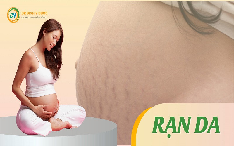 Đo Vòng Bụng Khi Mang Thai: Hướng Dẫn Chi Tiết Từ A Đến Z Cho Mẹ Bầu Bức ảnh cận cảnh vùng bụng dưới của một phụ nữ đang mang thai, cho thấy các vết rạn da màu hồng nhạt và đỏ xuất hiện dọc theo da, đặc biệt ở vùng bụng dưới và hai bên hông.
