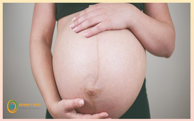 Đo Vòng Bụng Khi Mang Thai: Hướng Dẫn Chi Tiết Từ A Đến Z Cho Mẹ Bầu Bụng của một phụ nữ đang mang thai được nhìn từ phía trước, với một đường sọc màu nâu đậm chạy dọc từ rốn xuống xương mu, nổi bật trên nền da bụng.