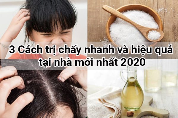 Những cách trị chấy tại nhà hiệu quả và an toàn cho mẹ và bé