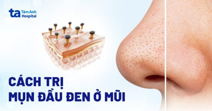 Trị mụn đầu đen bằng kem đánh răng: Sai lầm và Hướng dẫn Khoa học - image 1