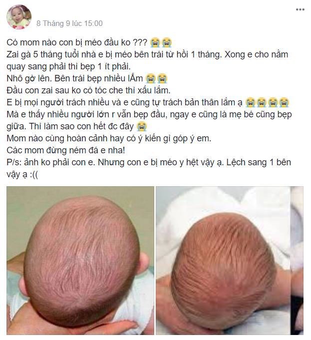 Cách Chữa Méo Đầu Cho Trẻ Hiệu Quả và An Toàn Tại Nhà