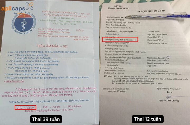 Giấy siêu âm với chỉ số đường kính lưỡng đỉnh theo tuần