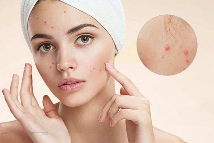 Làn da mụn cải thiện khi rửa mặt bằng sữa tươi đúng cách