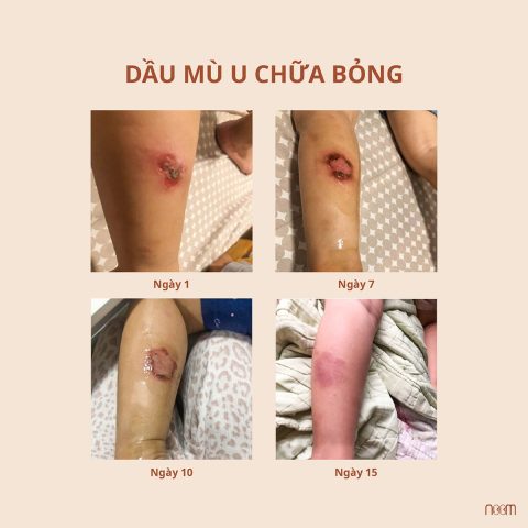 Dầu Mù U Vết Thương Hở: Hướng Dẫn Sử Dụng Và Lưu Ý An Toàn