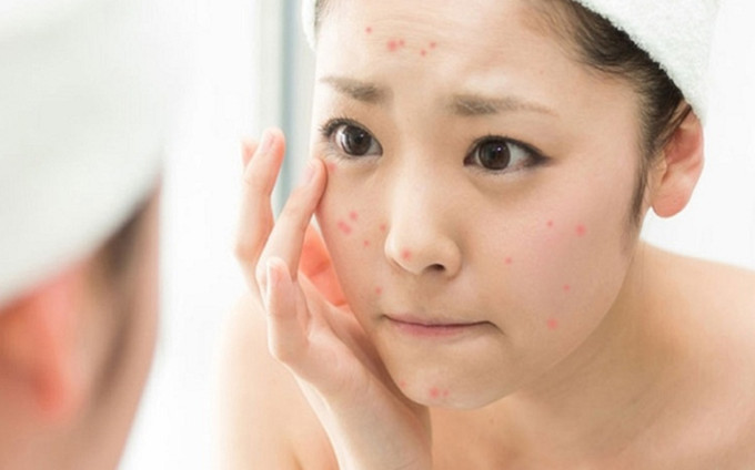 Da dầu thường bị nổi mụn do di truyền, chế độ ăn uống, nghỉ ngơi không khoa học