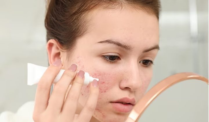 Bôi Kem Trị Mụn Khi Nào Để Đạt Hiệu Quả Tối Ưu Nhất?