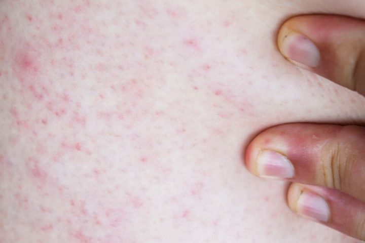 Da Nhạy Cảm Nên Đắp Mặt Nạ Gì? Hướng Dẫn Chăm Sóc Đúng Cách