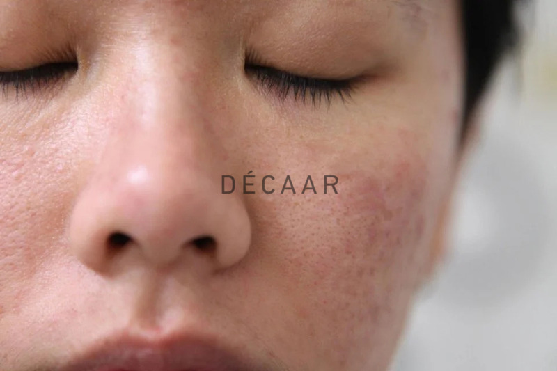 Cách Thải Độc Cho Da Mặt Hiệu Quả và An Toàn Tại Nhà