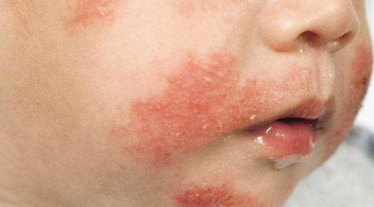Sữa cho Trẻ Dị Ứng Đạm Sữa Bò: Hướng Dẫn Toàn Diện