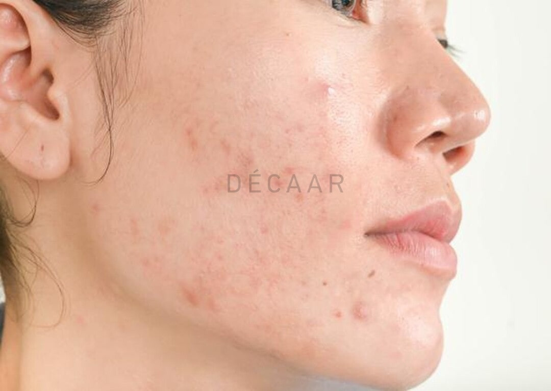 Điều trị mụn