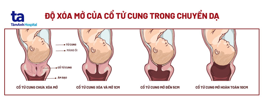 Dấu hiệu nhận biết cổ tử cung mở và bí quyết sinh nở dễ dàng