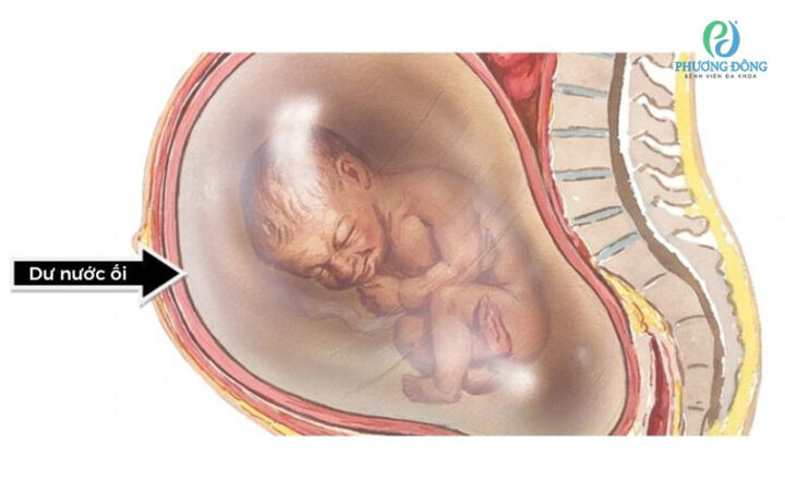 Dư nước ối là gì và cách khắc phục khi lượng dịch ối vượt quá mức bình thường