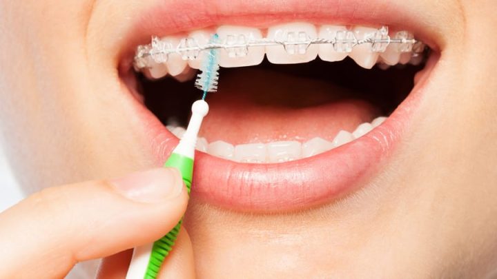 Bàn Chải Kẽ Răng Loại Nào Tốt? Hướng Dẫn Toàn Diện Từ Chuyên Gia