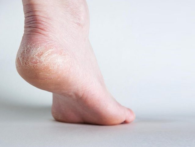 Chà Gót Chân Có Tốt Không? Lợi Ích & Cách Chăm Sóc Đúng Cách