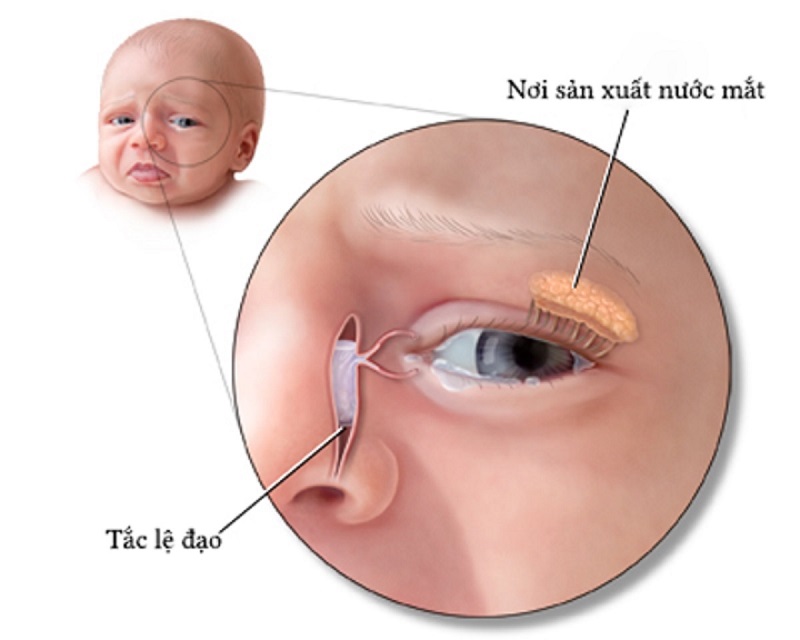 Tắc Tuyến Lệ ở Trẻ Sơ Sinh: Nguyên Nhân, Dấu Hiệu và Cách Chăm Sóc