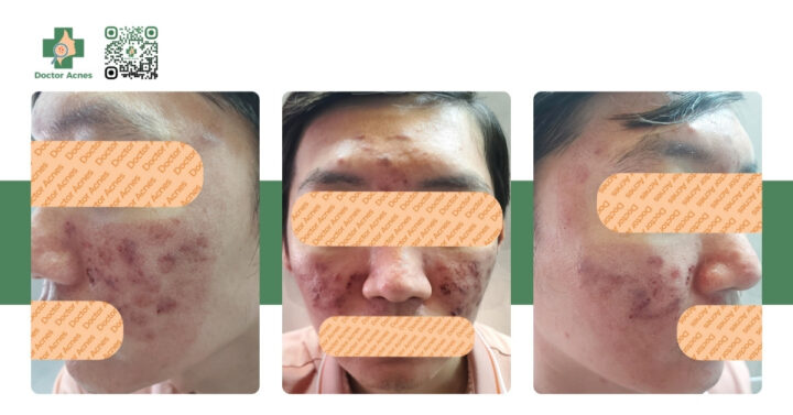 Hình ảnh lọ nước muối sinh lý dùng để làm sạch da sau các liệu trình xâm lấn, giải thích trường hợp nên rửa mặt bằng nước muối sinh lý.