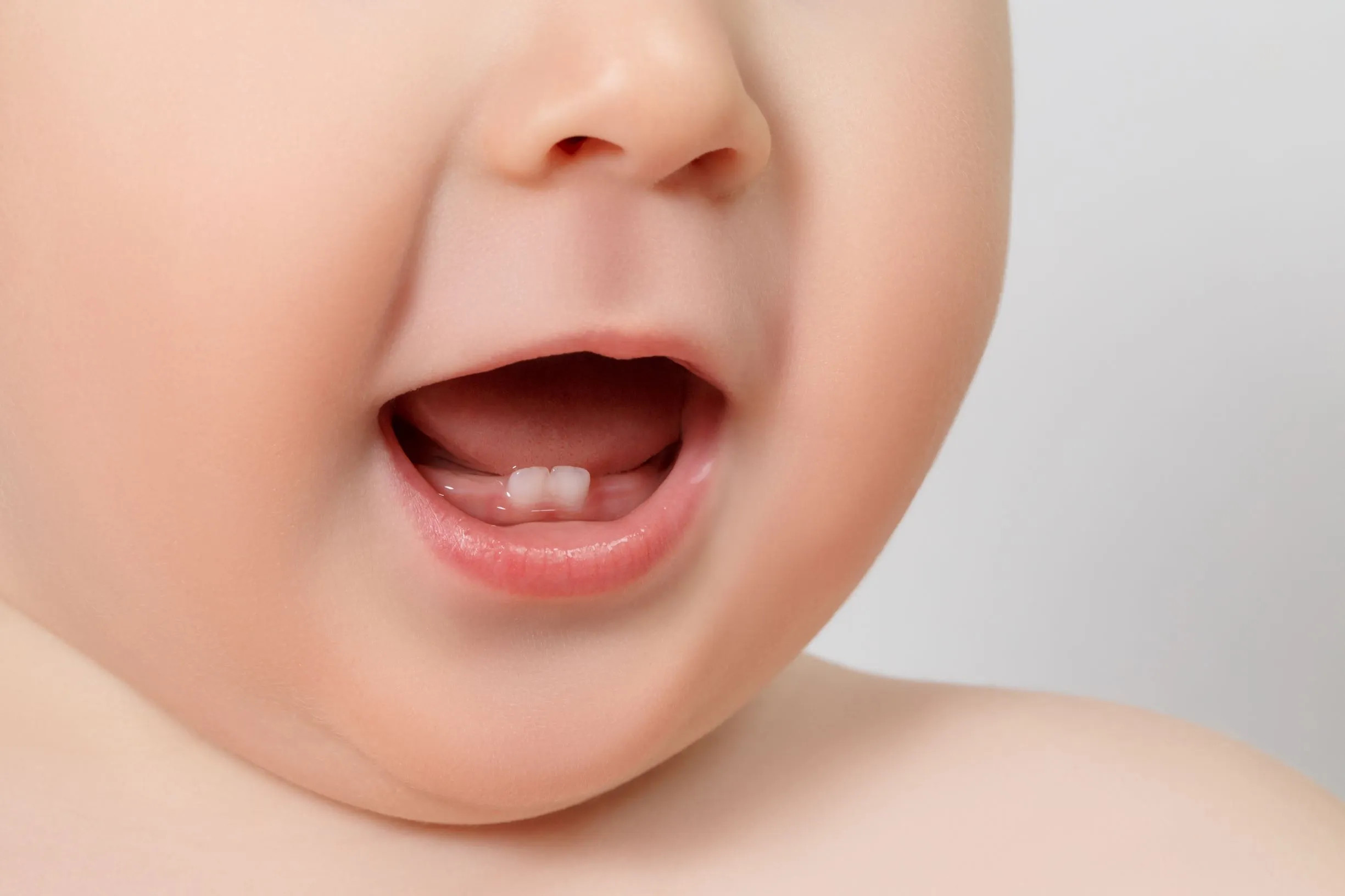 Hình ảnh minh họa hiện tượng nứt lợi mọc răng ở trẻ nhỏ