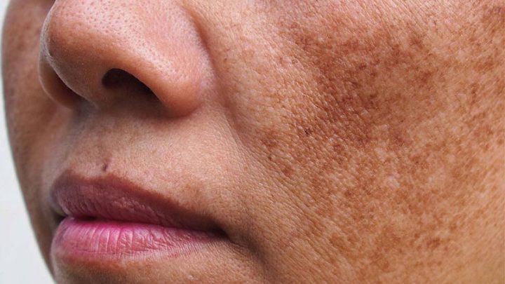 Trị nám hiệu quả nhất hiện nay: Giải pháp toàn diện cho làn da sáng mịn