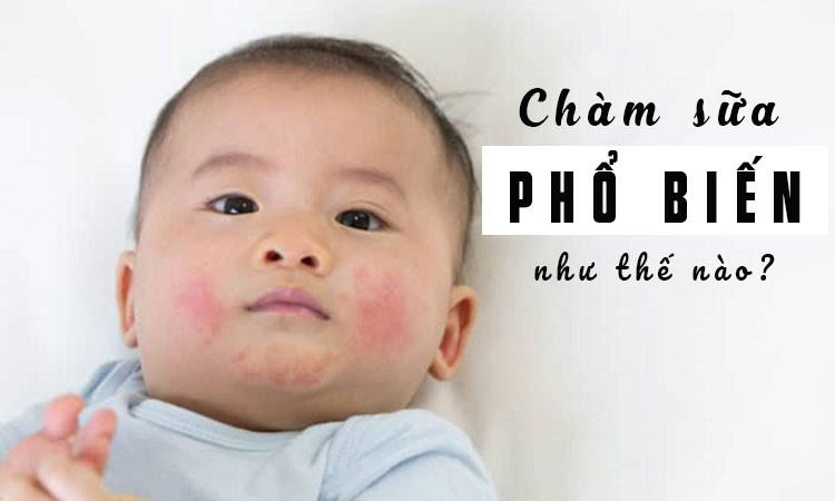 Kem trị chàm sữa cho trẻ sơ sinh: Hướng dẫn từ A đến Z